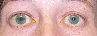 Pre-Operative Photograph showing upper eyelid retraction