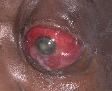 Orbital cellulitis